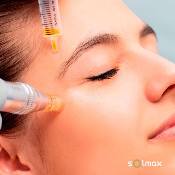 microneedling with Dermapen with vitamin cocktail at Solmax Santander