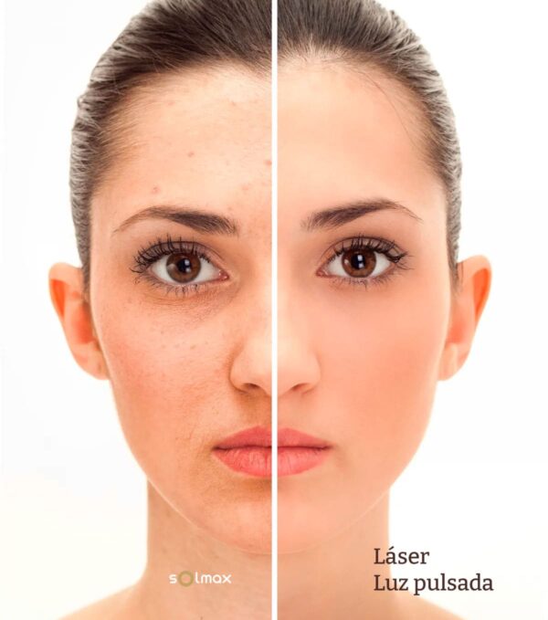 tratamiento fotorejuvenecimiento facial IPL en centro de estetica Solmax santander