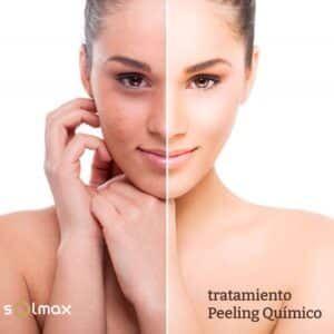 Tratamiento Peeling Químico en Solmax Santander