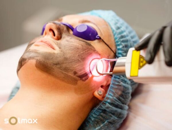 hollywood peel active carbon treatment at solmax aesthetic center santander