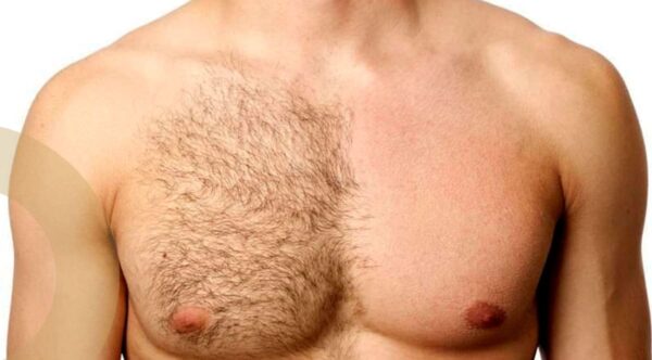 Chest hair removal for them at Solmax Santander